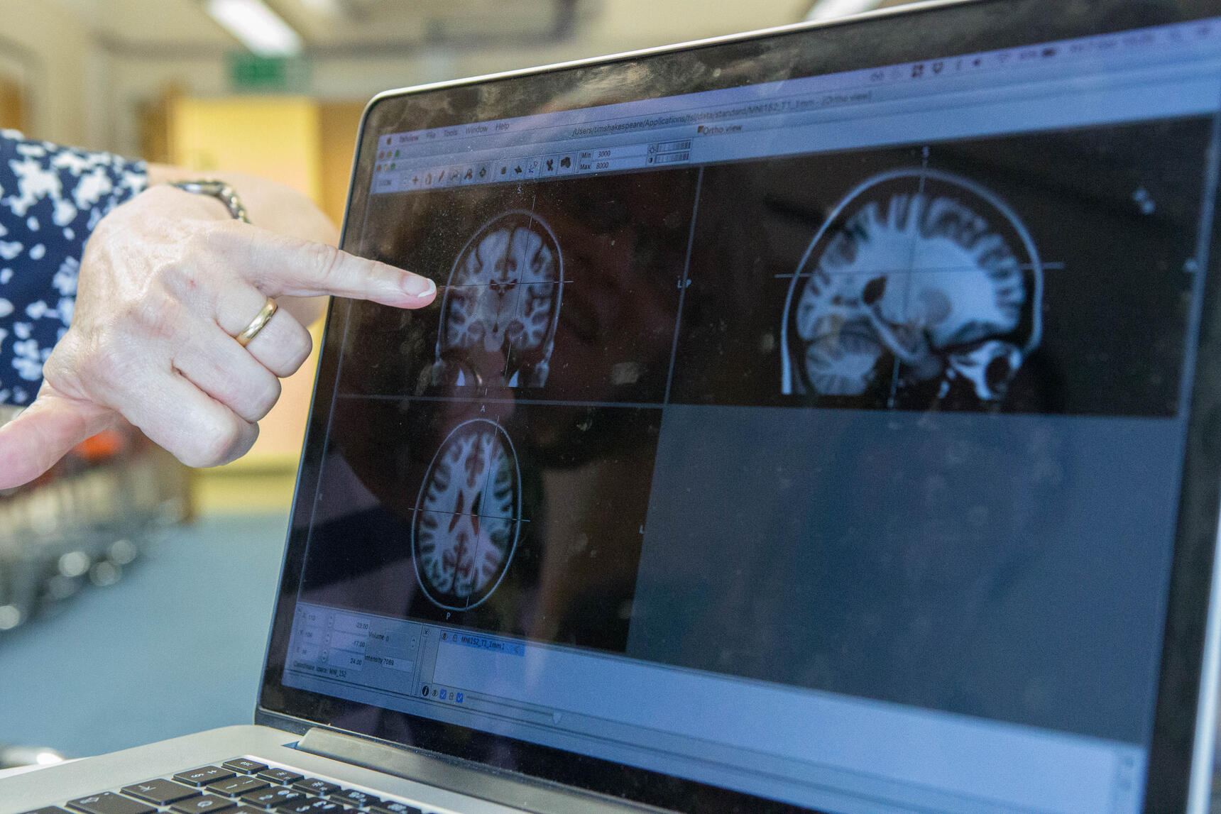 Researcher pointing at brain scan | Alzheimer's Society